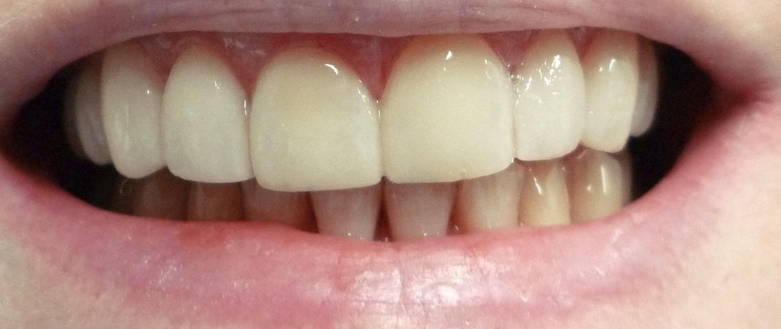 Teeth appearance after porcelain veneer placement