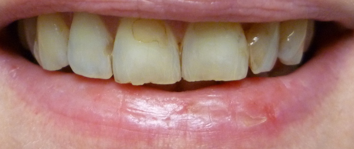 Teeth appearance before aesthetic dental restoration