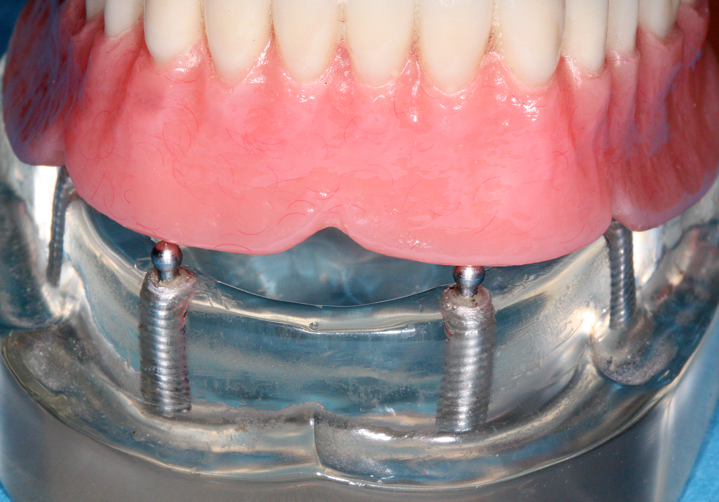 Dentures prosthetic model