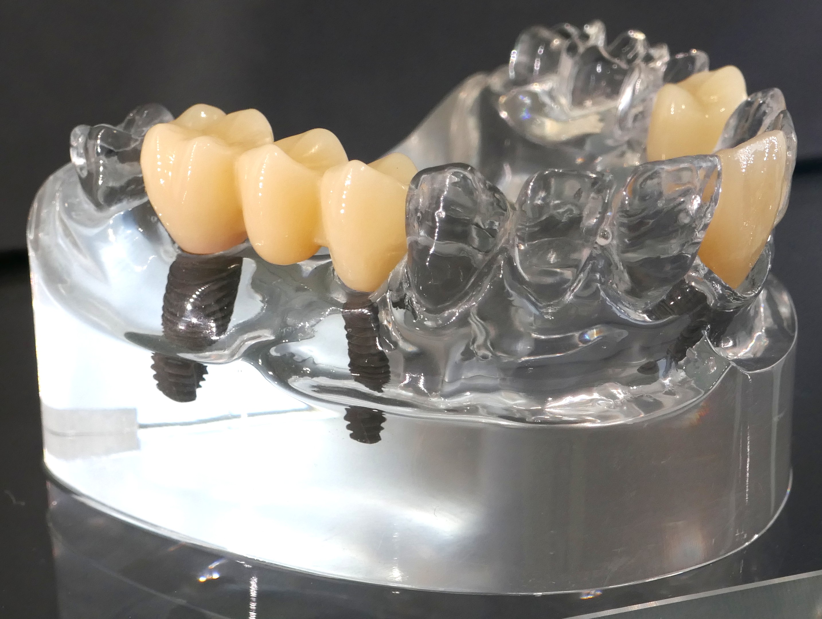 Dental implant titanium fixture placement