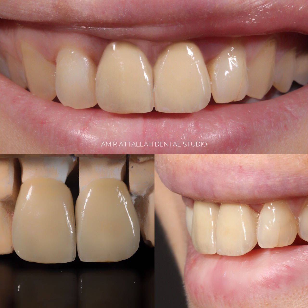Veneers and ceramic crown restoration